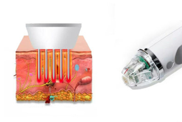 جوانسازی پوست با لیزر آر اف فرکشنال - RF Fractional