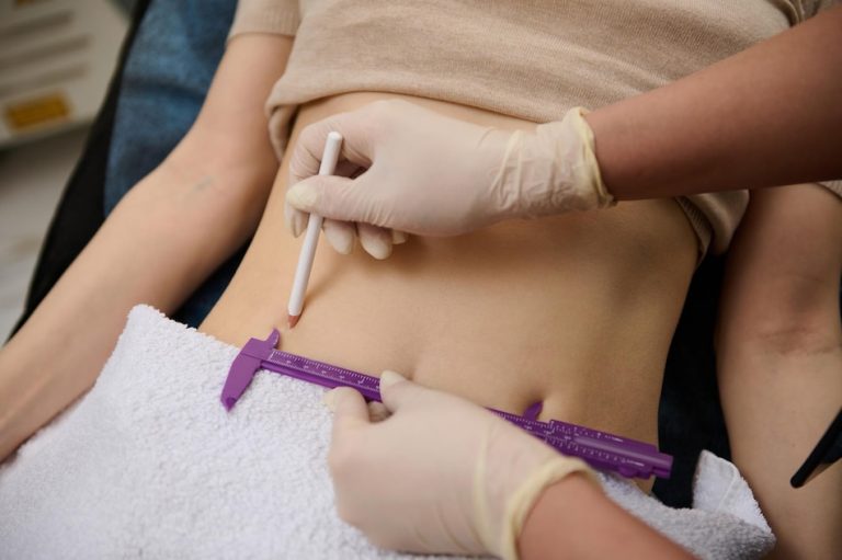 closeup cosmetologist measures level belly fat with caliper draws lines with white pencil woman s abdomen 328764 9529 768x511 - مزوتراپی چاقی موضعی (چربی سوز )