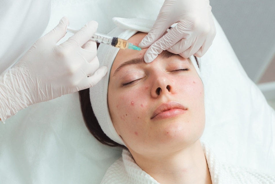 درمان اسکار آکنه (Acne scar treatment) - خدمات کلینیک شایلی