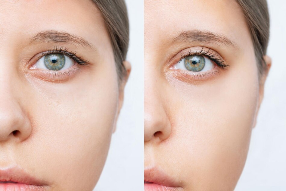 جراحی بلفاروپلاستی (blepharoplasty) - خدمات کلینیک شایلی